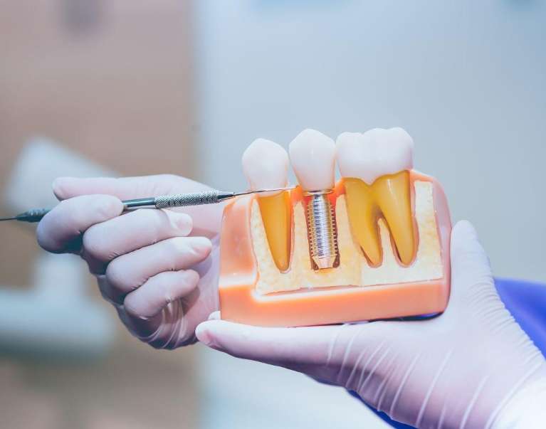 Close-up of dentist holding model to explain benefits of Dental Implants