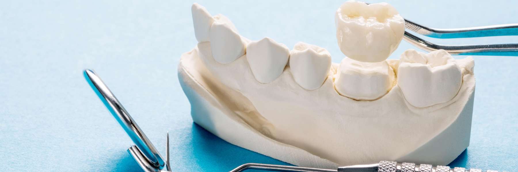 Crowns and Onlays | Dentist