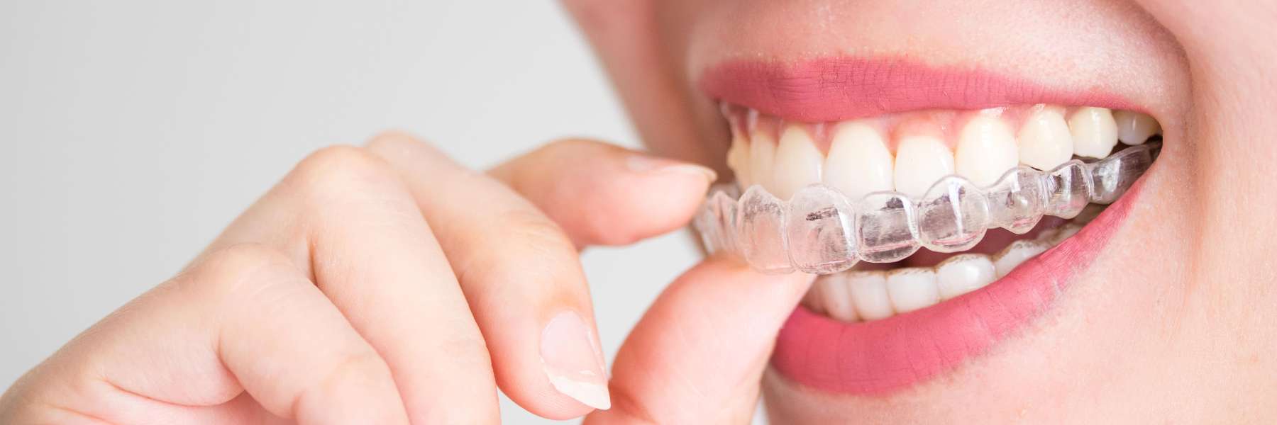 Invisalign® Clear Aligners | Dentist