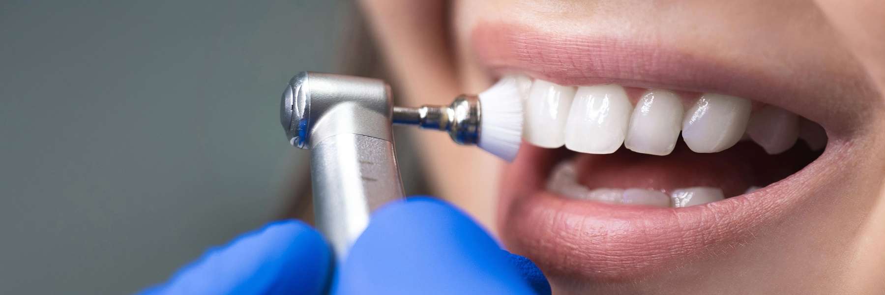 Tooth Cleaning | Dentist