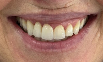 Seamless smile restoration with 3 unit bridges and 1 crown, replacing gapped, yellowed teeth with bright, natural-looking porcelain.