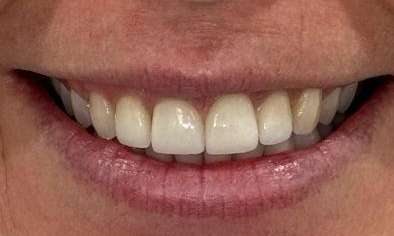 4-Porcelain-Veneers-Professional-Teeth-Whitening-and-Tooth-Recontouring-After-Image