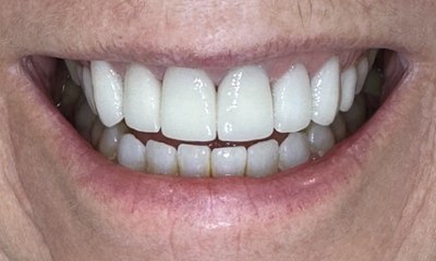 Close-up of the patient's smile after in-chair whitening and porcelain veneers, featuring bright, white, and perfectly shaped teeth for a rejuvenated look.