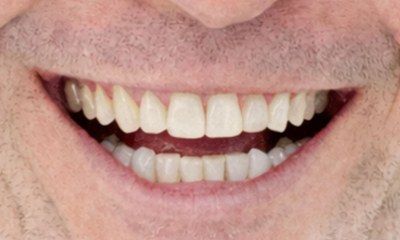 Close-up of a patient's smile before Invisalign treatment at Portside Dental, showing crowded and slightly misaligned upper and lower teeth.