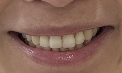 Close-up of the patient's smile after Invisalign treatment, displaying perfectly straight, even teeth and a wider, more symmetrical smile.