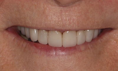 Close-up of a person's smile after dental treatment, displaying a bright, white, and perfectly uniform row of upper teeth enhanced by professional whitening and porcelain veneers.