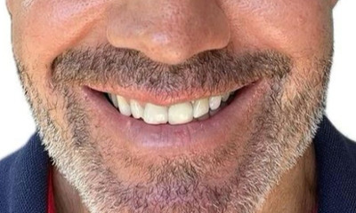 Man's smile after porcelain veneers showing a complete transformation with bright, white, and perfectly aligned teeth.