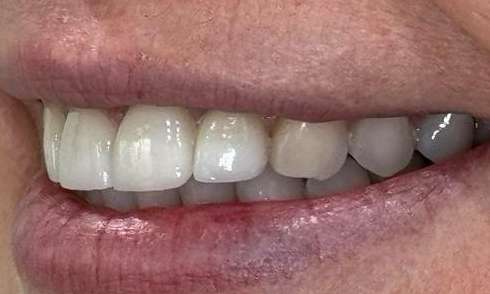 Portside Dental Whitening Veneers Recontouring After 1