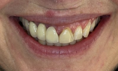 Smile restoration showing crooked, uneven teeth replaced by a seamless 3 unit bridge and 1 crown for a straight, bright result.