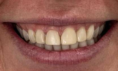 4-Porcelain-Veneers-Professional-Teeth-Whitening-and-Tooth-Recontouring-Before-Image