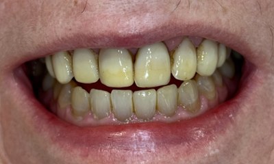 Close-up of a patient's smile before treatment at Portside Dental, showing yellowing, dental staining, and uneven tooth shapes on the upper arch.