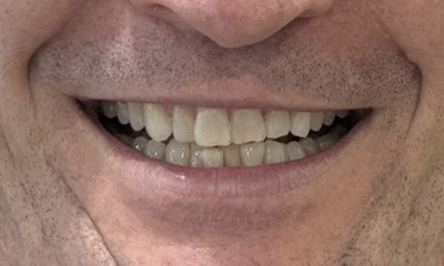Close-up of a patient's smile before Invisalign treatment at Portside Dental, showing crowded and slightly misaligned upper and lower teeth.
