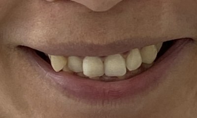 Close-up of a patient's smile before Invisalign at Portside Dental, showing crowded lower teeth and slight misalignment of the upper front teeth.