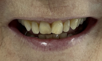 Close-up of a person's mouth before dental treatment, showing yellowed natural upper teeth with slightly uneven and chipped bottom edges.