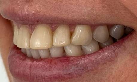 Portside Dental Whitening Veneers Recontouring Before 1